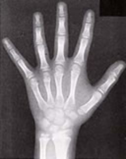 骨の成長発育度の評価のための手骨X線写真