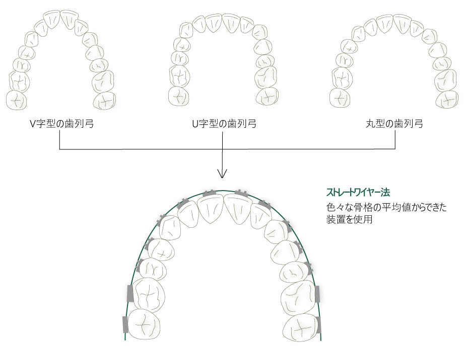 ストレートワイヤー法