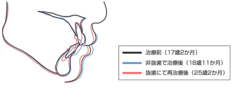 患者さんの例